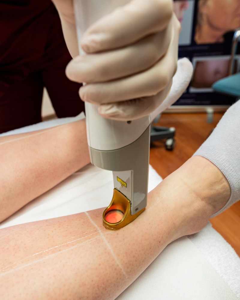 Épilation laser médicale